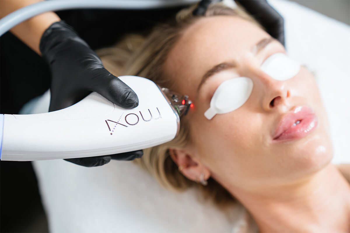 Moxi Laser in Los Angeles, CA Skin Rejuvenation in Los Angeles, CA