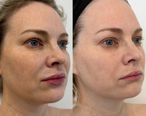 women before and after skin rejuvenation in Los Angeles