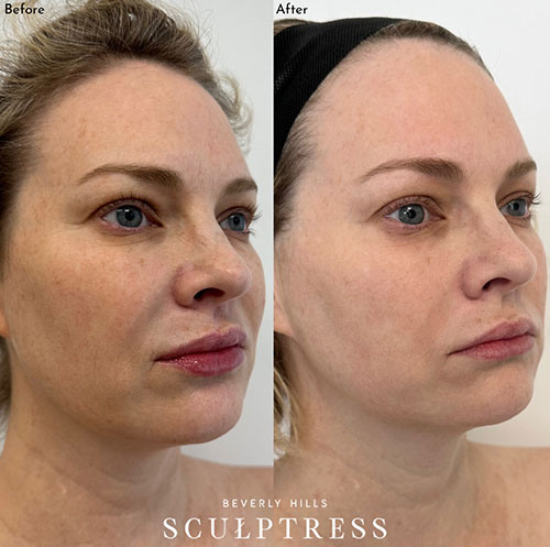 women before and after skin rejuvenation in Los Angeles