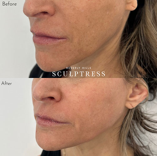women before and after skin rejuvenation in Los Angeles