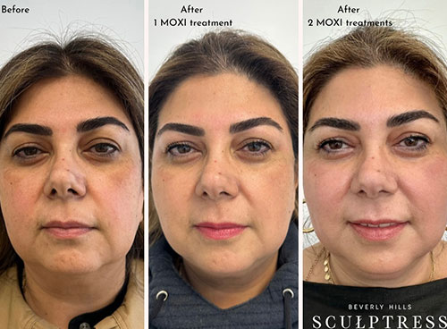 women before and after MOXI Laser in Los Angeles