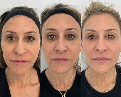 women before and after skin rejuvenation in Los Angeles