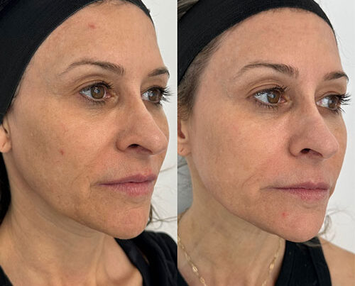 women before and after MOXI Laser in Los Angeles